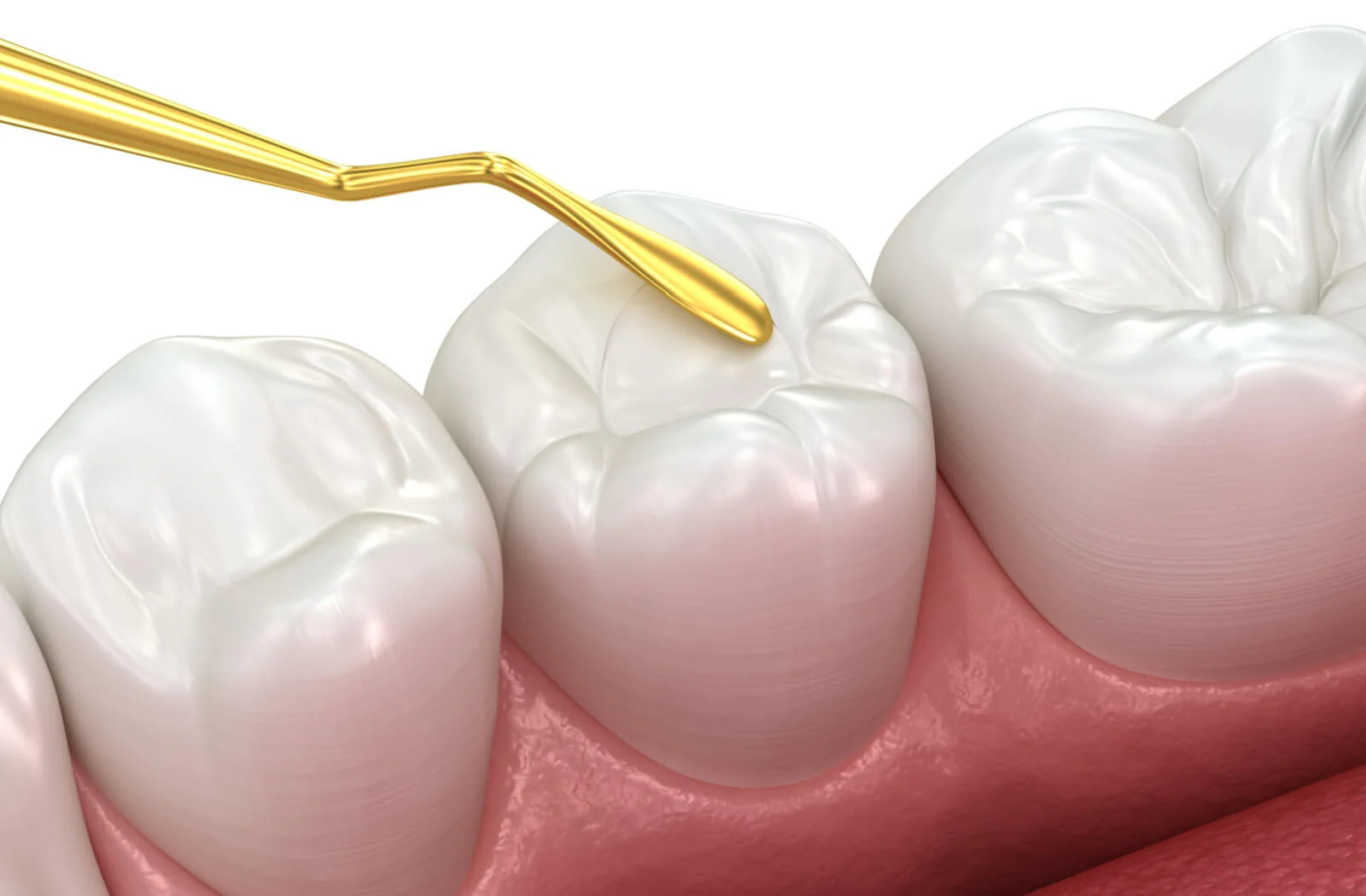 Featured image for “What Does CDCP Cover? Dental Fillings, Crowns, & More”